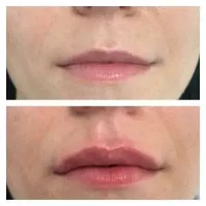 Filler labbra acido ialuronico 10